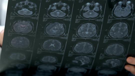 医生手拿影像片分析脑断层MIR摇头无法治愈视频素材模板下载