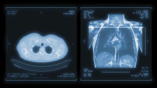 胸部肺部CT扫描MIP视图！