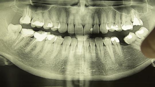 牙医X片照片