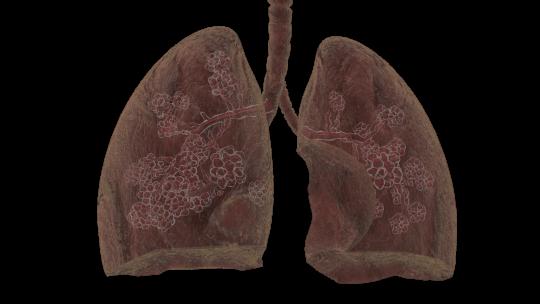 【4K透明通道】肺部病变机理动画视频素材模板下载