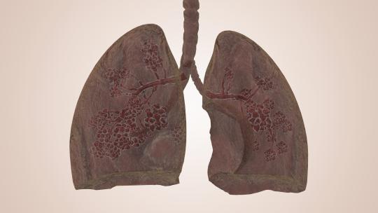 肺部感染病变机理