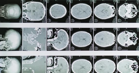头部x光片人类大脑的磁共振成像MRI