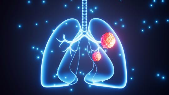 人类肺部肿瘤增长动画视频素材模板下载