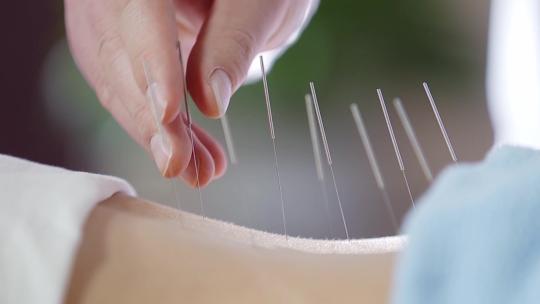 中医医疗治疗针灸减肥医生