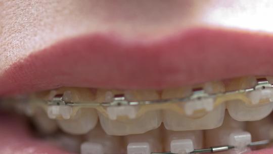 金属托槽牙齿矫正牙套视频素材模板下载