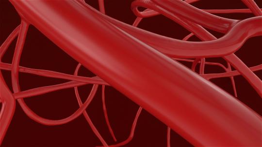 血管支架血管堵塞血栓视频素材模板下载