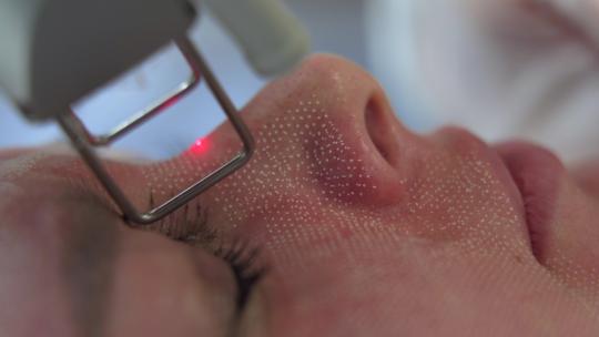 美容师做激光美容手术视频素材模板下载